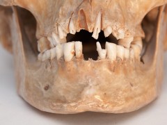 Stomatologia – jak kiedyś leczono zęby? Stomatologia – jak kiedyś leczono zęby?